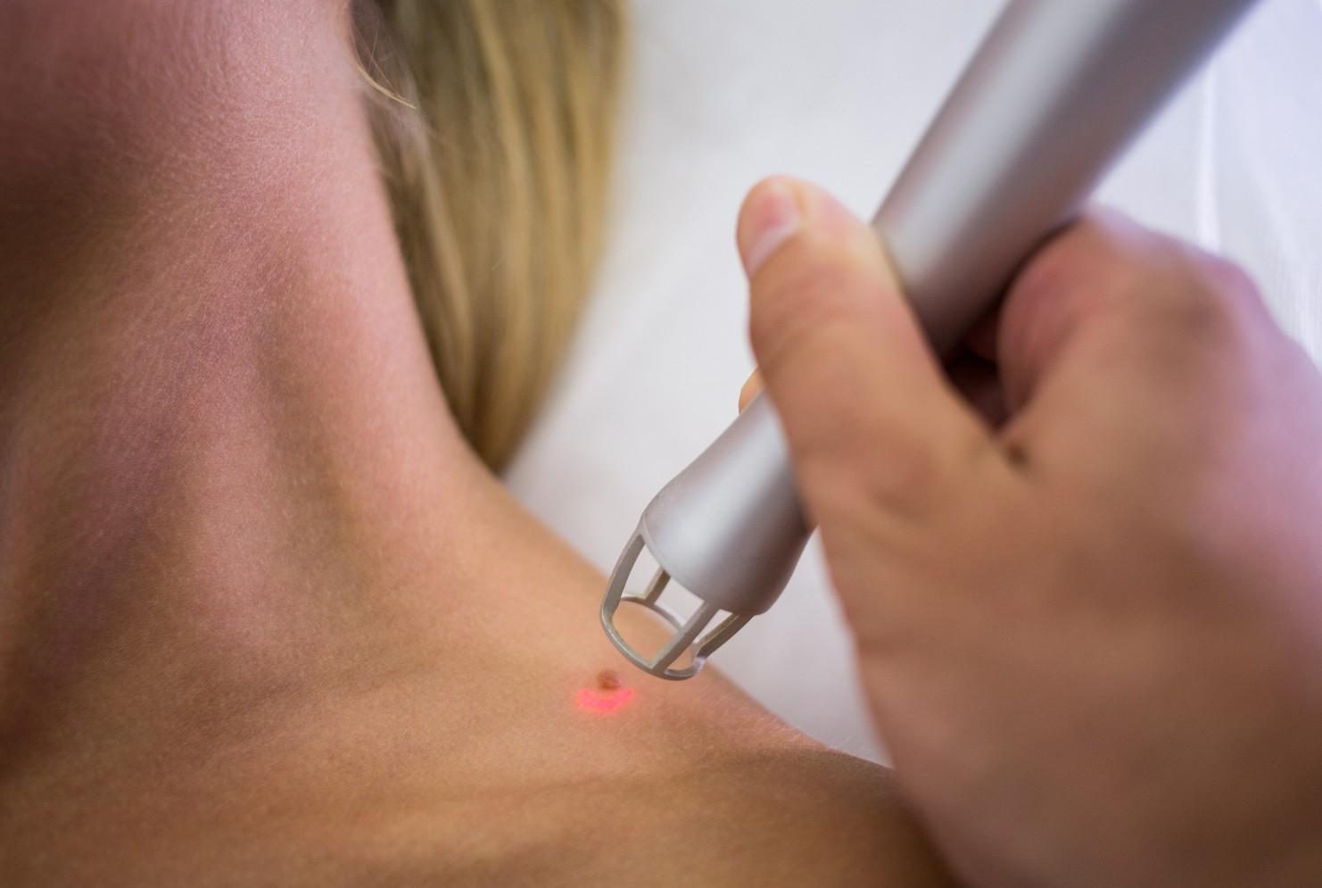 mole removal in Peterborough